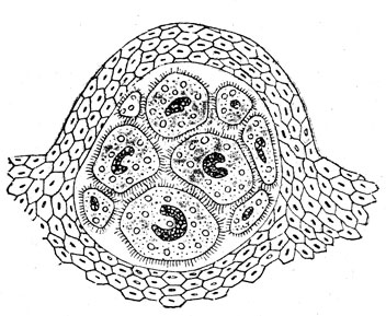 Рис. 31. - группа инфузорий, внедрившихся под эпителий